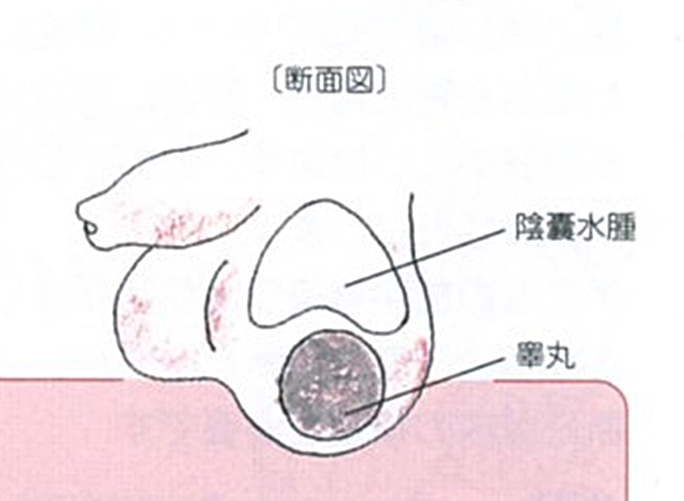 でき もの 睾丸 【精索静脈瘤の症状】睾丸・金玉の不快感/痛み/しこり/コブ/腫れ